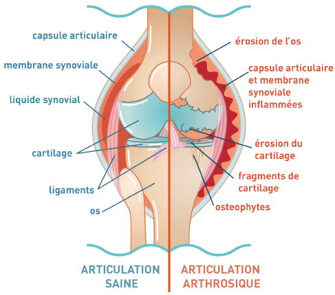 Tableau 1 - Schéma comparatif articulation saine / articulation arthrosique